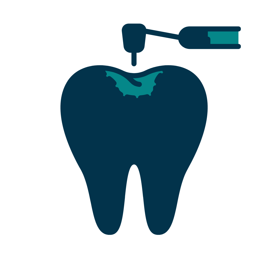 Dental Fillings